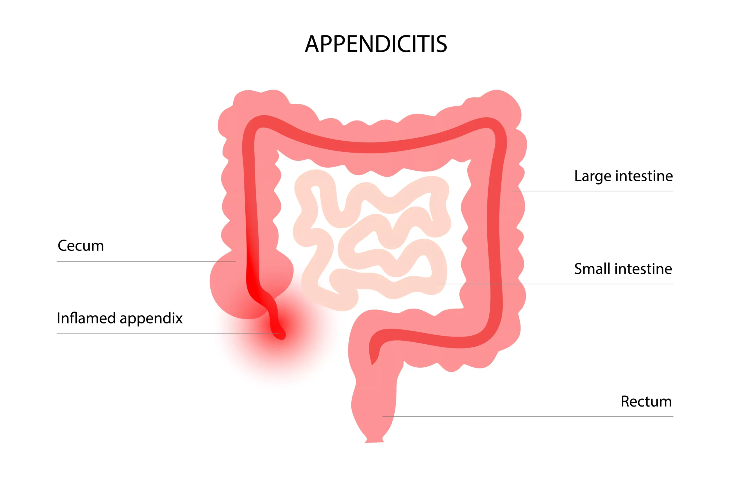 Appendix Surgery